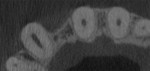 Fig 10. CBCT showed a buccal plate deficiency for tooth No. 6 with a limited overall ridge width.