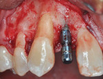Fig 11. Placement of 3.3-mm diameter implant. Note root convergence and buccal plate defect on tooth No. 6 and implant No. 7.