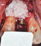 Fig 12. EMD placement on the root of tooth No. 6. Xenograft, collagen membrane, and CTG were also placed. A healing abutment was utilized on implant No. 7 to coronally advance the tissues for primary closure over the implant.