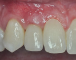Fig 14. Radiograph (Fig 13) and clinical photograph (Fig 14) of completed restoration. Note total root coverage on tooth No. 6 (restoration of implant No. 7 completed by Kyle Ostenson, DDS).