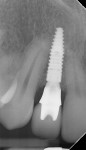 Fig 13. Radiograph (Fig 13) and clinical photograph (Fig 14) of completed restoration. Note total root coverage on tooth No. 6 (restoration of implant No. 7 completed by Kyle Ostenson, DDS).