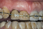 Fig 4. Space created distal to the canine after orthodontic treatment had closed space between lateral and central incisors.
