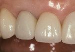 Fig 6. Retracted view (Fig 5) and close-up view (Fig 6) of full-mouth restorations with a combination of crowns and veneers (restorative treatment performed by David S. Hornbrook, DDS).