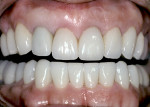 Fig 5. Retracted view (Fig 5) and close-up view (Fig 6) of full-mouth restorations with a combination of crowns and veneers (restorative treatment performed by David S. Hornbrook, DDS).