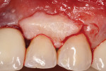 Fig 14. Palatal connective tissue graft matching lost interdental papilla dimensions.