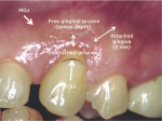 Fig 1. Class I recession. Note that the free gingival groove separates the unattached gingiva from the attached gingiva.