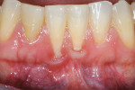 Fig 7. Class II recession with a type B papilla
between the central incisors. The papilla is <3 mm.