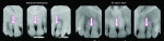 Fig 22. Comparison of radiographs taken 31 years apart (three on the left, initial; three on the right, 31 years later) revealed the efficacy of periodontal therapy. Bone density and volume appeared to have improved after periodontal surgery despite no guided tissue regeneration being performed.
