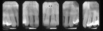Fig 23. Initial radiographs in 1989 of the patient in Case 3, who presented with more than 60% alveolar bone loss. Full-mouth SRP followed by fullmouth flap surgery, including maxillary anterior papillary retention treatment, was performed.