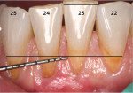 Fig 8. The papilla between teeth Nos. 24 and 25 is type A. The papilla between teeth Nos. 22 and 23 is type C. Note the interdental recession on the distal of No. 23 and the mesial of No. 22.