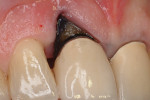 Fig 7. Case 3, patient presentation, Nordland Class III papillary defect involving root exposure of tooth No. 8. Fig 8. Contoured, papillary-shaped palatal connective tissue graft between teeth Nos. 7 and 8.