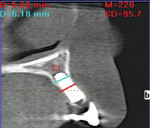 Figure 17  CBCT, tooth No. 7, posttreatment.
