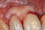 Fig 8. Contoured, papillary-shaped palatal connective tissue graft between teeth Nos. 7 and 8.