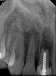 A good root canal may have been absorbed.
