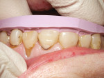 Figure 12  Enamel and gingival reduction: The incisal and buccal preparation guides (fashioned from the diagnostic wax-up) were used to verify proper reduction. Figure 14 shows the retracted view after gingival recontouring using a periodontal stint