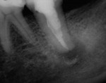 Postoperative radiograph showing internal composite build-up.