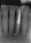 Postoperative radiograph showing resorption filled with gutta-percha followed by composite.