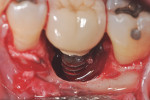 Photograph of the same implant, demonstrating the extent of soft-tissue loss.