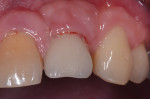Pretreatment photograph of the same implant, showing pus and bleeding.