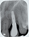 Pretreatment radiograph of an implant placed 14 years earlier that developed periimplant
mucositis.