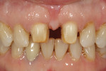 Veneer preparations for teeth Nos. 8 and 9.
