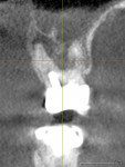 Enhanced 3D evaluation of tooth No. 15 exhibiting nonrestorable interradicular pathology and bone destruction