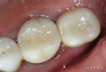 Final treatment image for tooth No. 15.