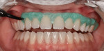 Retractors were placed to isolate the soft tissues, the soft tissues and teeth were dried, and a gingival barrier was placed around the teeth
that would receive the in-office whitening treatment.