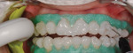 A 38% hydrogen peroxide in-office whitening gel was applied to all of the facial surfaces of
the teeth and left to sit for a total of 15 minutes.