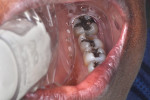 Broken distobuccal cusp on tooth No. 18.