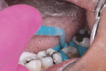 Aquasil Ultra+ LV being applied around the prepared tooth.