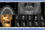 Fig 2. CBCT helps the team identify the accurate placement of maxillary implants.