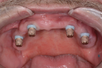 Fig 6. Friction fit caps are blocked out with denture wax to relieved retentive anatomy and silicone sleeves trimmed prior to reline impression.