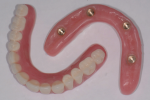 Fig 11. Note how the flanges are cut back to reveal more of a bridge instead of a denture, as shown in this cameo and intaglio view of final prosthetics.