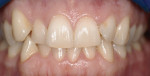 Figure 3  This retracted close-up image shows irritated gingival embrasures and squeezed and misshapen interdental papilla.
