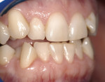 Figure 4  This image shows a broken arch form, crowded dentition, squeezed and misshapen interdental papilla, and loss of arch length as a result of crowding.