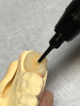 Fig 8. Ceramage UP T-Glass is used to cover the buccal, lingual, and interproximal areas.