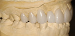Figure 5  The diagnostic wax-up created to correct the tooth position and the crowding in the dental arch.