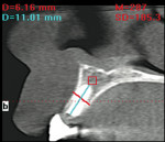 Figure 19  CBCT, tooth No. 10, posttreatment.