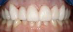 Figure 7  The provisional restorations in place. The gingival architecture was corrected using a diode laser.