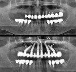 Fig 1. External hexed Co-Axis implants with 12°, 24°, and 36° subcrestal angle correction.