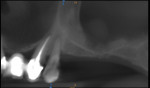 Fig 2. Preoperative image (Fig 1) and radiograph (Fig 2) showing lack of sufficient bone in the premolar site.