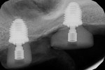 Fig 6. Three implants were placed, including two Ultra-Short implants (radiograph view in Fig 6) measuring 4.5-mm diameter x 4.1-mm long, externally hexed.