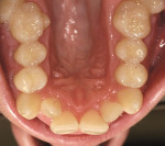 Figure 10  The collapsed arch form and the crowded teeth of the maxillary arch.