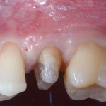 Fig 9. Posterior tooth to be extracted.