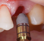 Fig 11. Implant with domed apical end.
