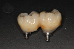 Fig 21. Two Ultra-Short implants were placed and splinted together.