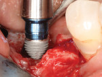 Fig 20. Two Ultra-Short implants were placed and splinted together.
