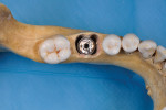 Fig 2. Ultra-wide-diameter implant (Southern Implants’ MAX) for immediate placement in molar extraction sockets.