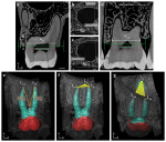 Fig 3. Examples of maxillary first molar measurements on sections and on 3D model.